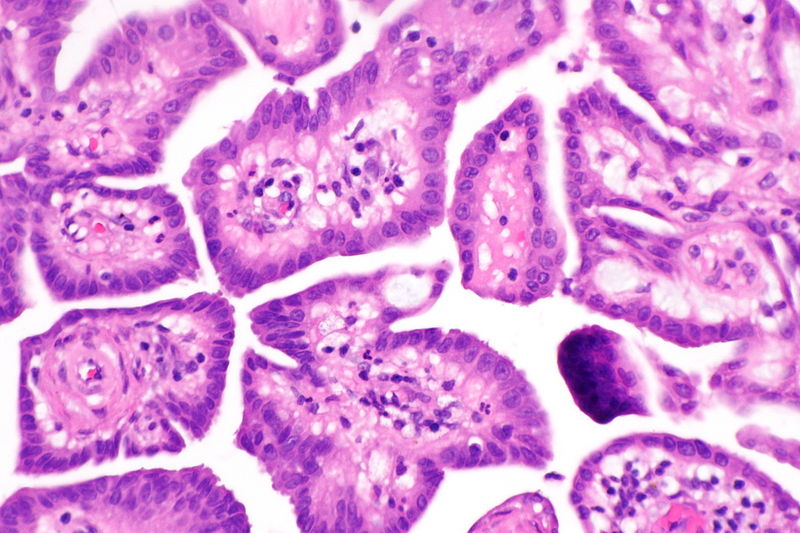 File:Well-differentiated papillary mesothelioma -- high mag.jpg