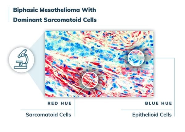 Biphasic mesothelioma with dominant sarcomatoid cells